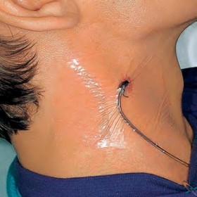 Hydrofilm plus transparenter klebeverband aus polyurethan 9 x 10 cm 5 stk.