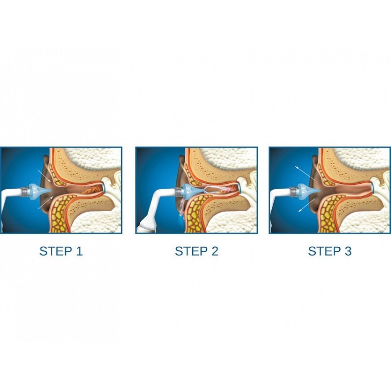 Kit otoclear - 1 kit