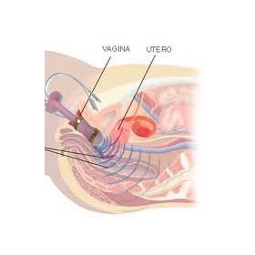 Eletroestimulador perineal para incontinência beac intellistim be-28ug