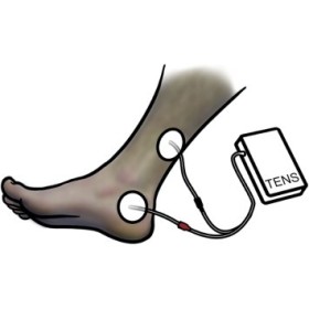 Perineal elektrostimulator til inkontinens beac intellistim be-28ug