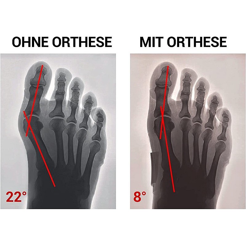 Epitact - flexible tages-korrekturorthese - medien