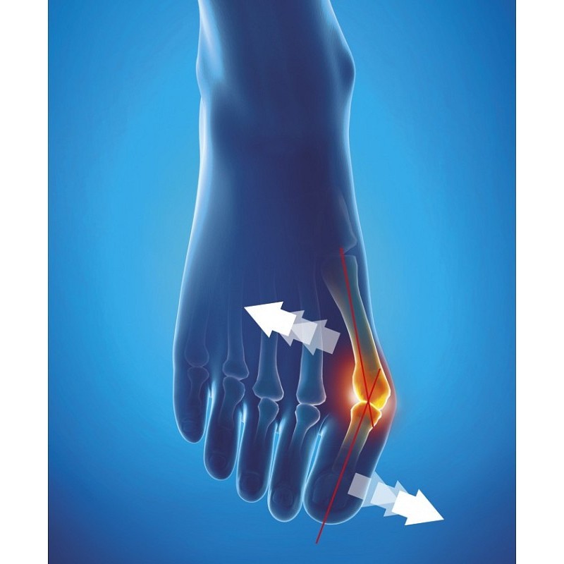 Epitact - flexible day corrective orthosis - media