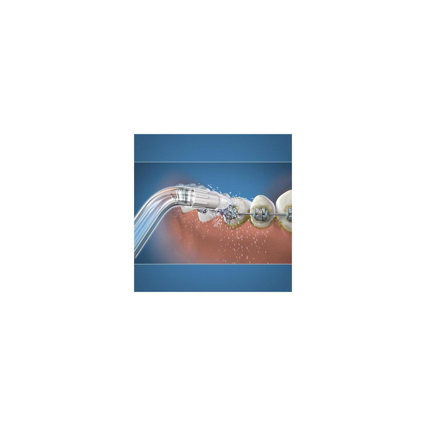 Waterpik - Punta per idropulsore ortodontica OD-100E - 2pz