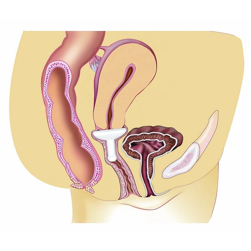 Gellhorn silicone pessary for 2nd-3rd-4th degree prolapses, cystocele and rectocele